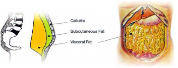 内臓脂肪は致命的な毒である