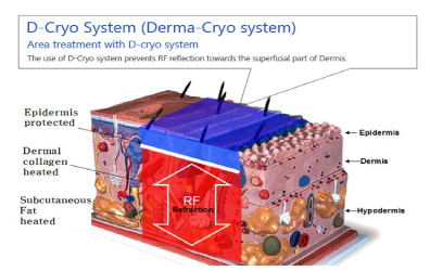 D-Cryo システムのメリット